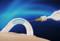 Contraceptivo masculino por implante avança em testes na Austrália