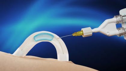 Adam é um hidrogel solúvel em água que é implantado nos canais que transportam o esperma