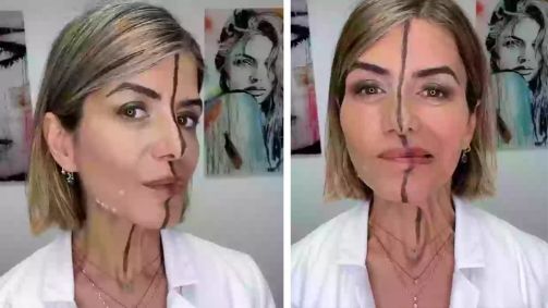 Bita Farrell publicou vídeo em que fala da aplicação de botox em apenas um lado do rosto
