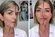 Médica aplica botox em apenas um lado do rosto para mostrar efeitos; veja