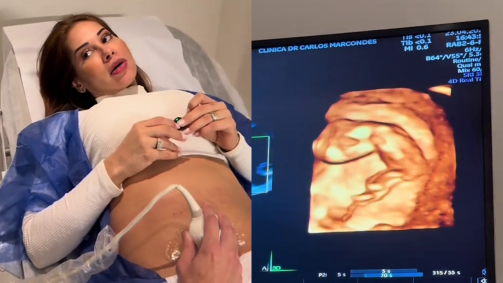 A influenciadora divulgou recentemente que descobriu um diagnóstico de trombofilia, condição que aumenta a predisposição de formação de coágulos no sangue