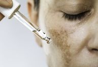 Melasma: saiba qual é a melhor rotina para clarear as manchas