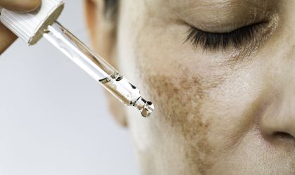 Condição é marcada pelo surgimento de manchas escuras na região da face