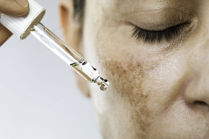 Condição é marcada pelo surgimento de manchas escuras na região da face