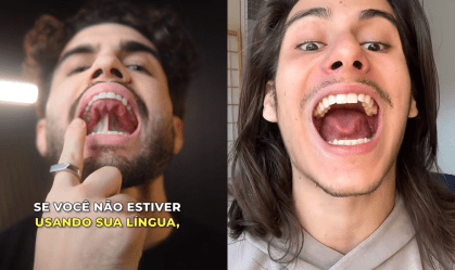 Mewing define a mandíbula? Conheça riscos do exercício viral do TikTok
