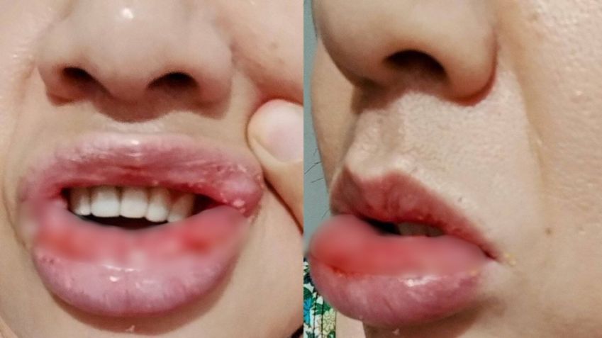 Clientes relataram reações após uso do creme dental • Arquivo pessoal