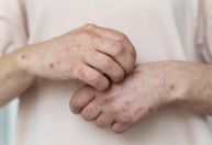 Sarampo: saiba quais são os sintomas, transmissão, tratamento e prevenção