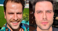 Ex-BBB Gustavo celebra harmonização facial: "Ainda não acabou"