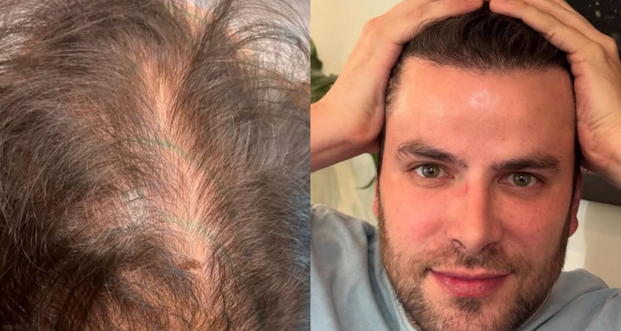 Gustavo mostrou o antes e depois do seu transplante capilar no Instagram • Instagram/Gustavo Marsengo
