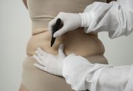 Cirurgia bariátrica é para quem não responde a tratamentos, diz médico