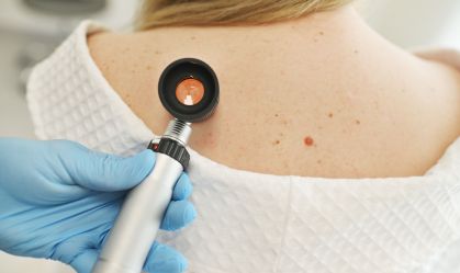 83% dos melanomas no mundo são causados por raios ultravioleta, diz OMS