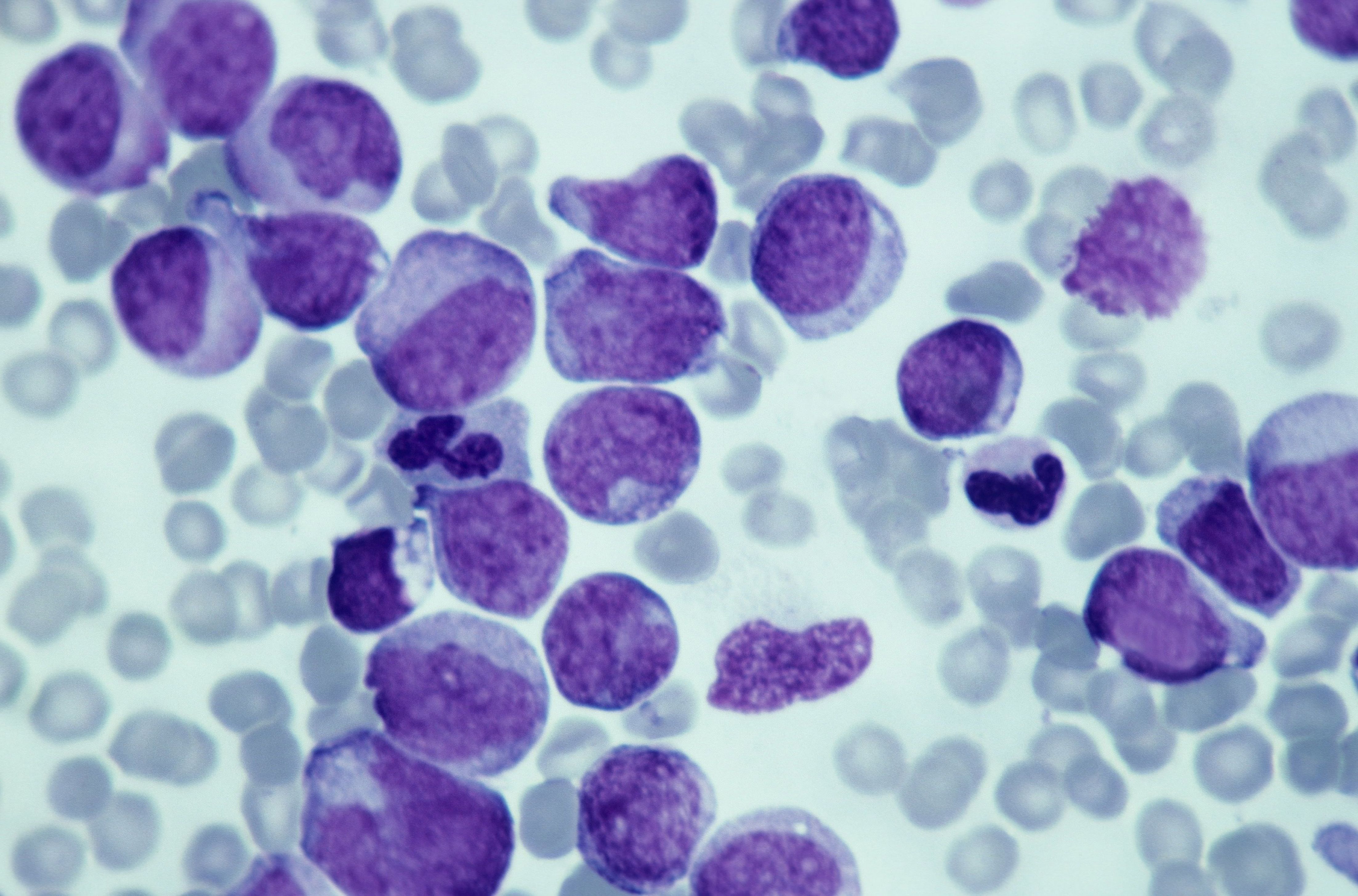 Células cancerígenas