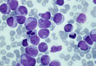 Novo estudo descobre como proteína afeta crescimento de células de câncer
