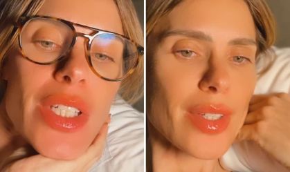 Carolina Dieckmann relata reação alérgica nos lábios após voo