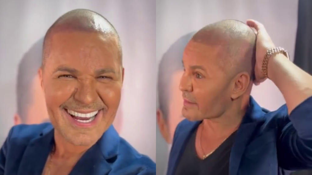 Eduardo Costa faz transplante capilar e cita motivo de perda dos fios; veja | CNN Brasil