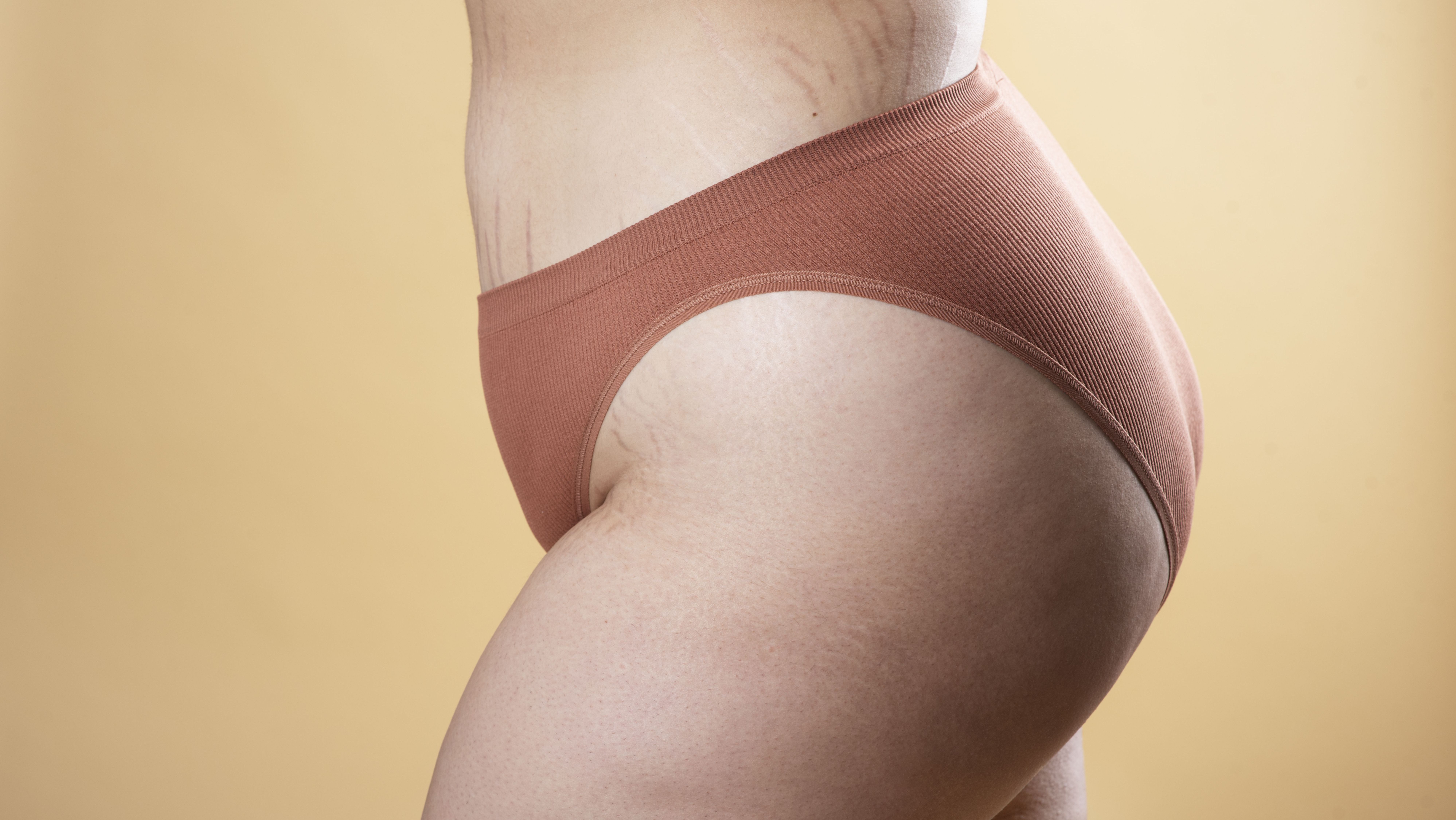 Estrias podem ser potencializadas por diferentes fatores