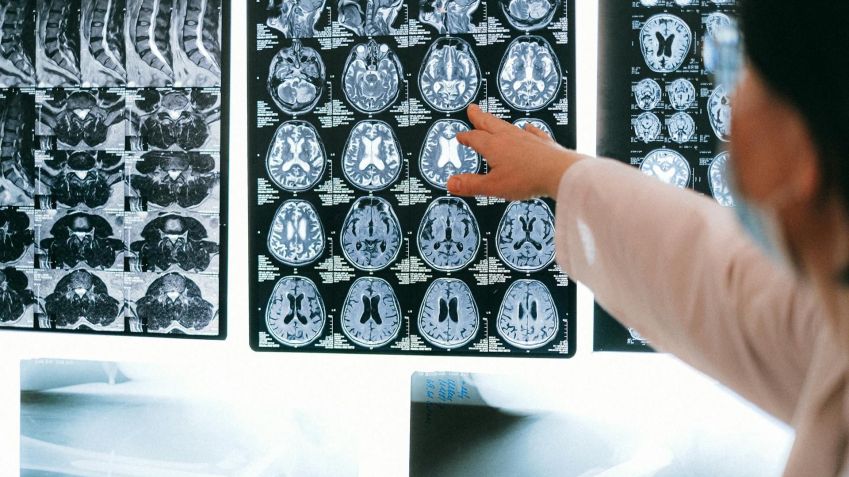 Better understanding how brain hemispheres communicate is a first step for effective treatments • Anna Shvets/Pexels