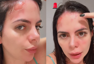 Grávida, ex-Casamento às Cegas sofre acidente com panela de pressão; veja