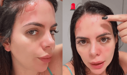 Grávida, ex-Casamento às Cegas sofre acidente com panela de pressão; veja