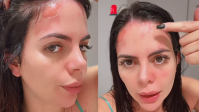 Grávida, ex-Casamento às Cegas sofre acidente com panela de pressão; veja