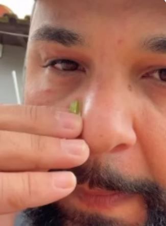 Léo Oliveira apareceu passando babosa no rosto após queimadura • Instagram/Léo Oliveira