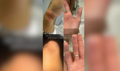 Ex-namorada acusa MC Brisola de agressão e mostra lesões na internet