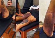 Juliano Cazarré mostra hematomas durante fisioterapia após cirurgia