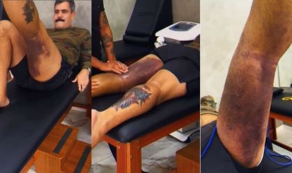 Juliano Cazarré mostra hematomas durante fisioterapia após cirurgia