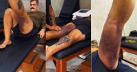 Juliano Cazarré mostra hematomas durante fisioterapia após cirurgia