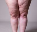 Como identificar lipedema? Veja sintomas e principais exames