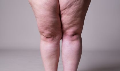 Como identificar a doença lipedema? Veja sintomas e principais exames