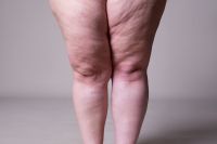 Lipedema e linfedema: entenda as diferenças e como tratar