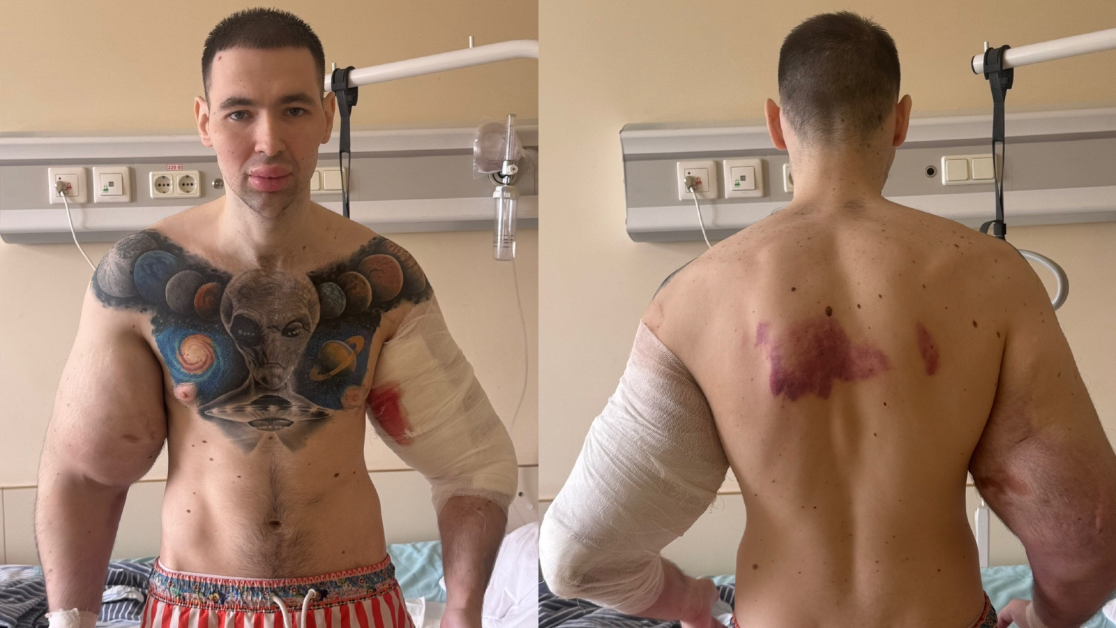 Nas fotos e vídeos publicados, ele compartilhou um momento no hospital em que seu braço está com um curativo e sangrando