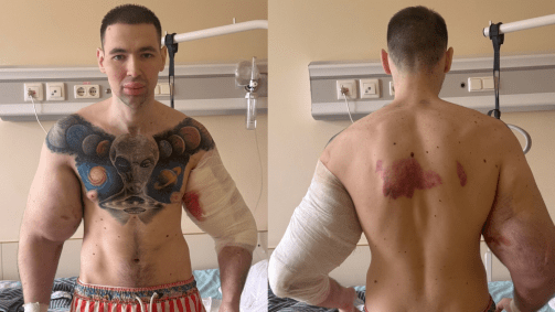 Nas fotos e vídeos publicados, ele compartilhou um momento no hospital em que seu braço está com um curativo e sangrando