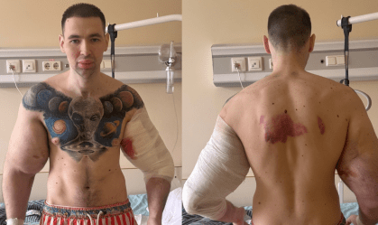 Nas fotos e vídeos publicados, ele compartilhou um momento no hospital em que seu braço está com um curativo e sangrando