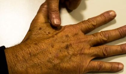 Casos de câncer de pele em idosos dispararam nas últimas três décadas
