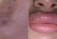 Mulheres denunciam falsa biomédica por danos após procedimentos em SC