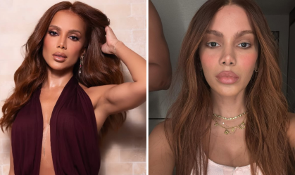 Anitta confirma procedimento estético, mas não detalha qual