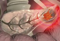 Câncer de pâncreas: cirurgia é opção de tratamento, mas nem sempre é viável