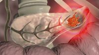 Câncer de pâncreas: cirurgia é opção de tratamento, mas nem sempre é viável