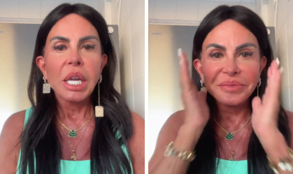 Gretchen mostra resultado de nova harmonização: "Não existe desarmonização"