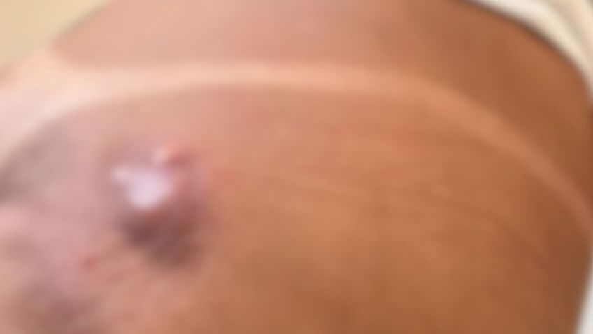 Giezica contou que já no primeiro dia após o procedimento nos glúteos sentiu dor, teve febre e percebeu a formação de um hematoma na região • Divulgação