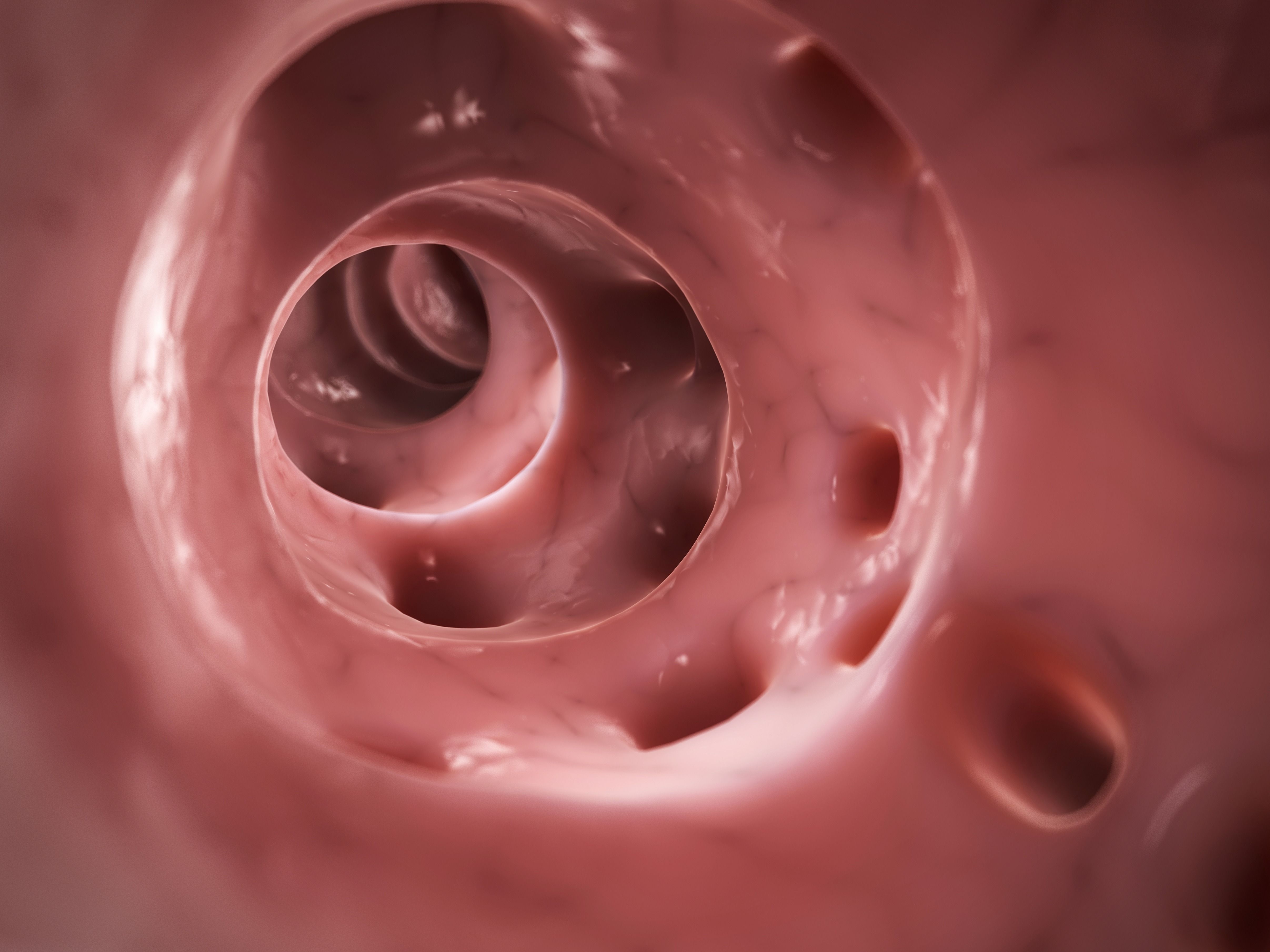 Diverticulitis, illustration