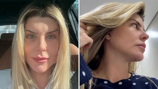 Ex-BBB Iris Stefanelli mostra mudanças no rosto após cirurgiais