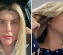 Ex-BBB Íris mostra mudanças no rosto após combo de cirurgias; confira