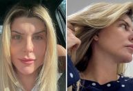 Ex-BBB Íris mostra mudanças no rosto após combo de cirurgias; confira