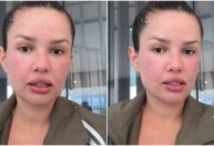 Juliette mostra rosto após procedimento com esperma de salmão; veja