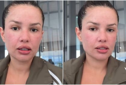 Juliette mostra rosto após procedimento com esperma de salmão; veja