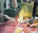 Pela 1ª vez na história, robô faz cirurgia guiado por IA sem ajuda humana