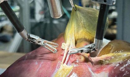 Pela 1ª vez na história, robô faz cirurgia guiado por IA sem ajuda humana